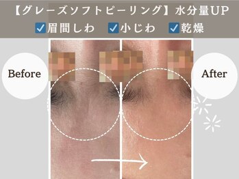 アンジュ(ANGE)/グレーズソフトピーリング症例