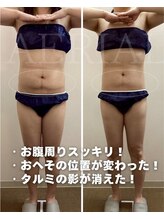 エアリアル 大川店/お腹/ウエスト/下腹脂肪冷却痩身