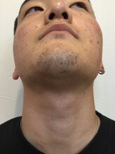 ディークロス(D cross)/メンズヒゲ脱毛