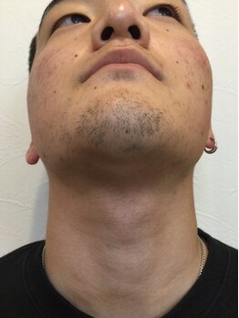 ディークロス(D cross)/メンズヒゲ脱毛