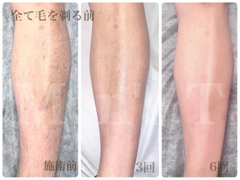 メンズ ティ(Men's T)/下半身脱毛