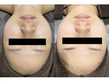 ラヴィアンローズ 泉店 (La vie en Rose)/イロンハーブピーリング