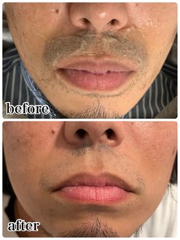 ケースタイル(k.style)/ヒゲ脱毛before after