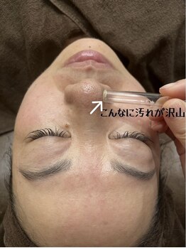 A&A 小山VAL店/毛穴