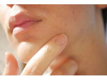 アレッド 大阪店(ared.)/顔脱毛！