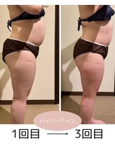 若松整体院 太白区院/痩身人気No.1★ハイパーナイフ