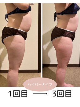 若松整体院 太白区院/痩身人気No.1★ハイパーナイフ