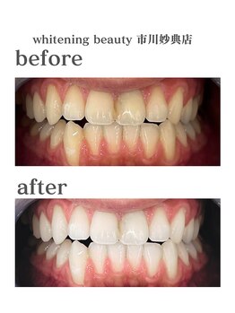 ホワイトニングビューティー 市川妙典店/歯科提携/ホワイトニング/妙典