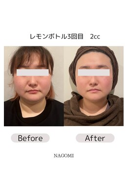 なごみ/脂肪分解【レモンボトル】