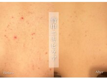 シューラディアント(ShuRadiant)/背中ニキビケア/鎮静