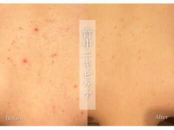 シューラディアント(ShuRadiant)/背中ニキビケア/鎮静