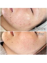 リセ(Rise')/ハーブピーリング