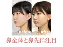 ラプリ 仙台店(Raplit stella)/隆鼻矯正+輪郭40分 10回