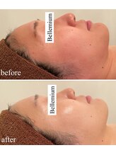 ベレミアム(Bellemium)/赤み改善、リフトアップ