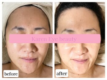 カレン アイビューティー(Karen Eyebeauty)/ララピールでツヤ肌美白☆