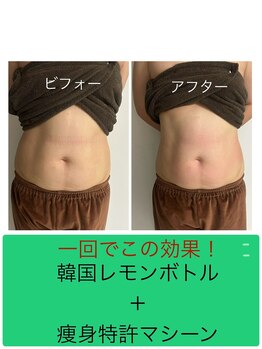 メディカルエステ ユウ(Yuu)/韓国脂肪分解　レモンボトル