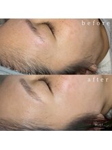 イクスト 吉祥寺(IKUST)/【フェイシャルワックス/脱毛】