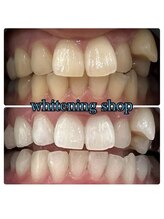 ホワイトニングショップ 池田店/【BEFORE/AFTER】