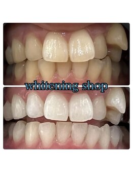 ホワイトニングショップ 池田店/【BEFORE/AFTER】