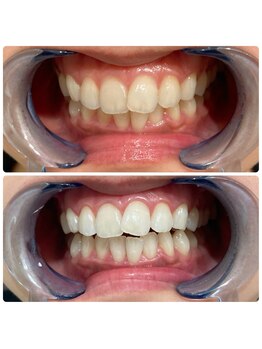 エクシアホワイトニング 日本橋店/初回ホワイトニング