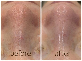 ペルボヌール 深井店/剥けないハーブピーリング1回