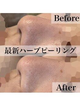 エステティックサロンR/ハーブピーリングで毛穴も綺麗に