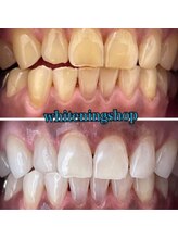 ホワイトニングショップ 熊谷店/【ヤニ汚れも♪】