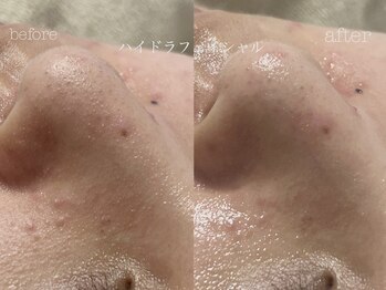 キアラ(CHIARA)/ハイドラフェイシャル