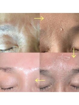 プルームドゥクレ(plume de cle')/SPハーブピーリング