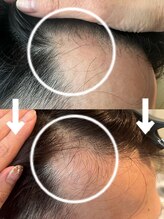 ルーチェ(LUCE)/頭皮グリーンピール