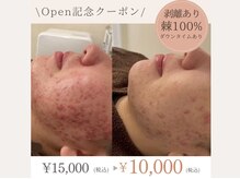 ミレア 恵比寿(MIREA)の雰囲気（Open記念キャンペーン中♪♪#ニキビ#ハーブピーリング#毛穴）