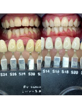 トウキョウスワーズ 池袋店(TOKYO SWRS)/#ホワイトニング #池袋 #渋谷