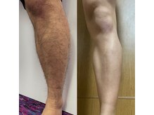 オーシャンブルー 長崎店(OCEAN BLUE)/メンズ脱毛