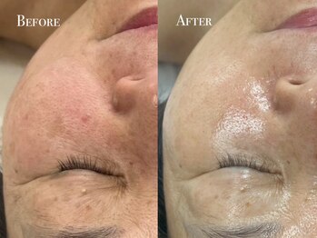 イースト(EAST)/シミプラズマフルコース1回