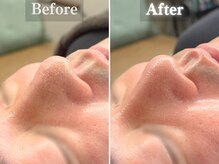 ボーンオム(Born Homme)/毛穴洗浄＋美容液導入：40代男性