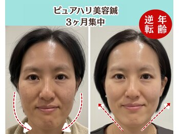 ピュアハリ/沖縄美容鍼/たるみ/効果