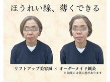 望鍼灸院の雰囲気(ビフォーアフター【シワ/ほうれい線/たるみ/肩こり/美容鍼】)