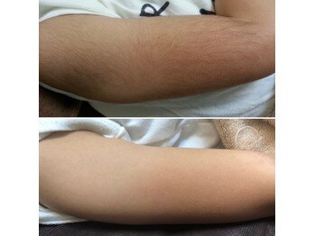 ウルル 栄店(ULULU)/腕の脱毛の症例♪