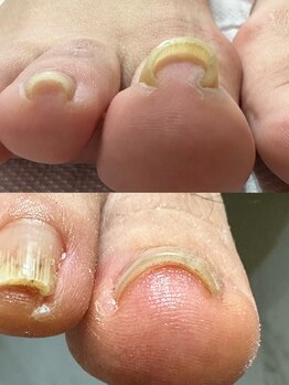 カンパニュラ(Campanula)/巻き爪ケア