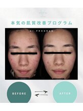 エーティーセンターラボ(At.center labo)/結果の出るニキビプログラム