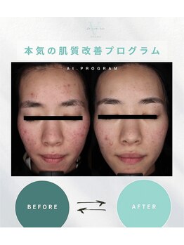 エーティーセンターラボ(At.center labo)/結果の出るニキビプログラム