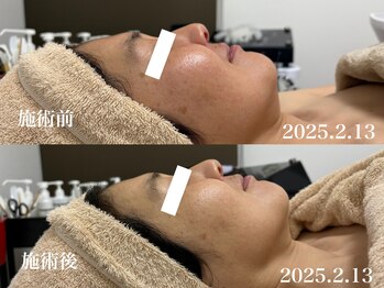 キーオブフェイス(Key of Face)/お悩み【くすみ】