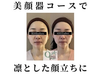 キュープ 函館店(Qpu)/美顔器モニターコース4回の変化