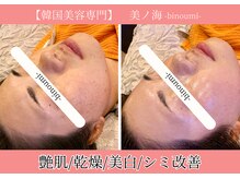 悩み肌特化!!韓国肌管理が自慢♪ニキビケア/毛穴/小顔/シミ/美白