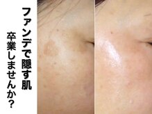 ベルスキン(Bell skin)