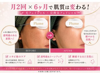 プルーム(Plume)/6ヶ月の肌育成結果(シミケア)