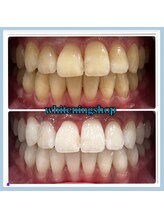 ホワイトニングショップ 堺東店/【ビフォーアフター】10回