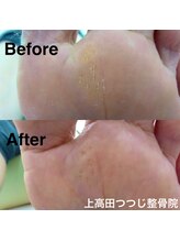 上高田つつじ整体院/フットケア　魚の目ケア