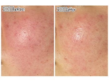 おうちサロン ミキ/漢方ハーブピーリングで肌質改善