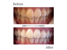 ブランの雰囲気（3回照射症例【プレミアムホワイトニング】効果に自信があります）